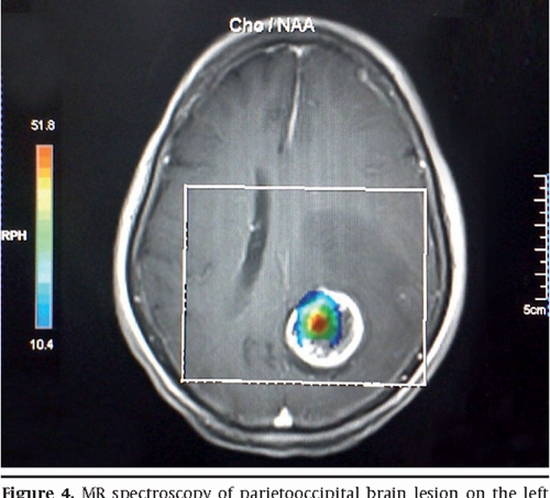 Diagnostic Accuracy of Cystic Brain Tumors  {faces}